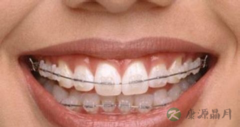 矫正牙齿后的饮食