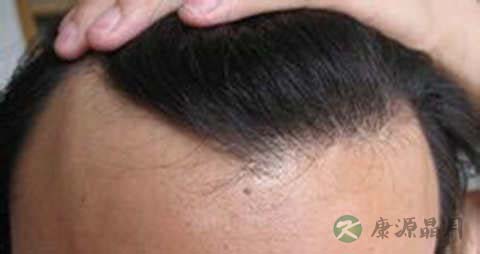 头发稀少脱发怎么办 头发稀少脱发怎么办