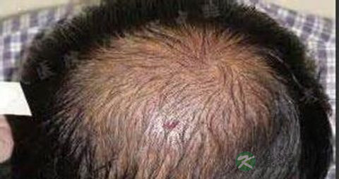 怎么治疗脂溢性脱发 怎么治疗脂溢性脱发