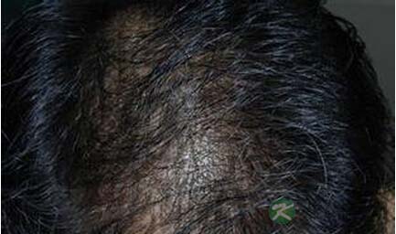 治疗掉头发的简单方法 治疗掉头发的简单方法