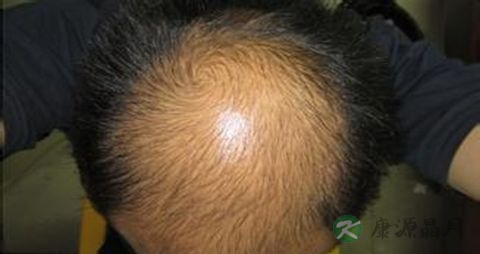 头发掉吃什么好 头发掉吃什么好