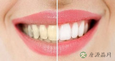 怎样才能让牙齿美白 怎样才能让牙齿美白