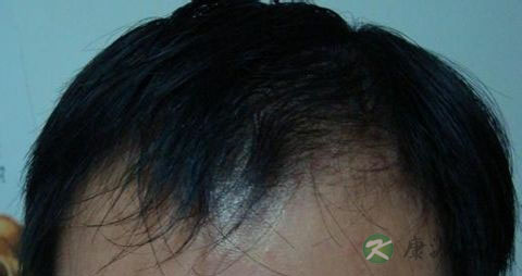 肾虚脱发用什么洗发水 肾虚脱发用什么洗发水