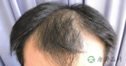 肾虚脱发还会长头发吗