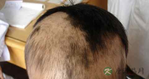 孩子掉头发怎么回事