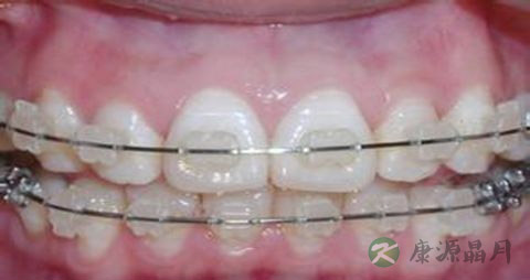 吃什么食物对牙龈好 吃什么食物对牙龈好