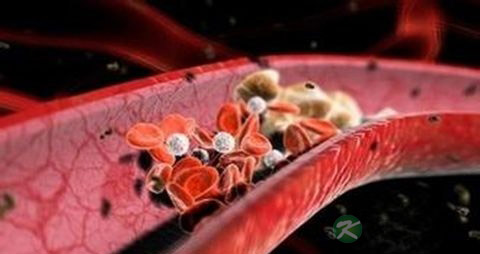 腿血栓吃什么药 腿血栓吃什么药