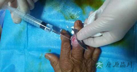 风湿吃什么食物 风湿吃什么食物