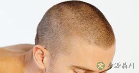 雄性脱发的原因
