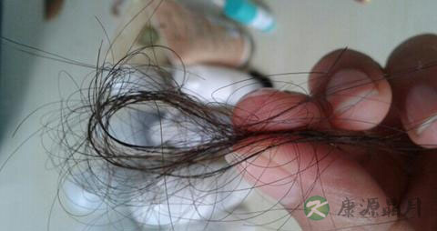 掉头发厉害的原因