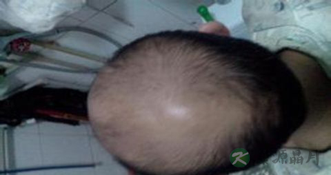 怎么治疗脂溢性脱发 怎么治疗脂溢性脱发