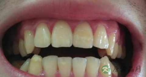 牙齿黄吃什么 牙齿黄吃什么