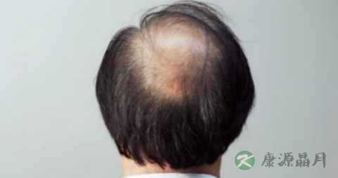 头顶掉发怎么办 头顶掉发怎么办