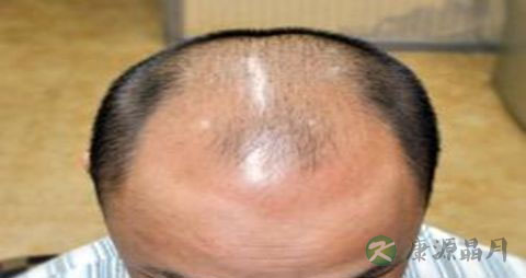 男人脂溢性脱发怎么办 男人脂溢性脱发怎么办