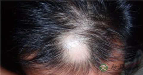 治疗头顶脱发的方法