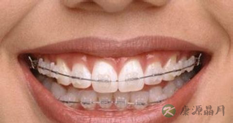 牙齿矫正后能吃什么