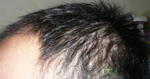 脂溢性脱发治疗时间