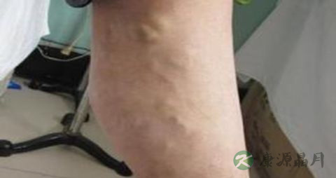 腿血栓吃什么药 腿血栓吃什么药