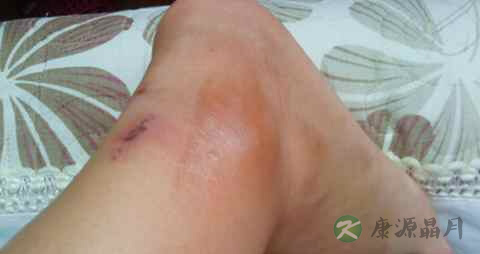 深静脉血栓饮食 深静脉血栓饮食