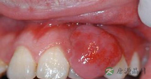 牙龈肿痛 吃什么 牙龈肿痛 吃什么