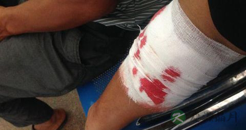 手臂骨头断了吃什么好