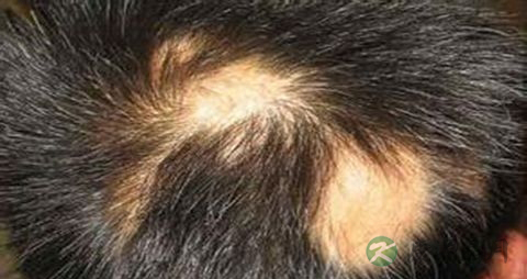 中医治疗脱发方法