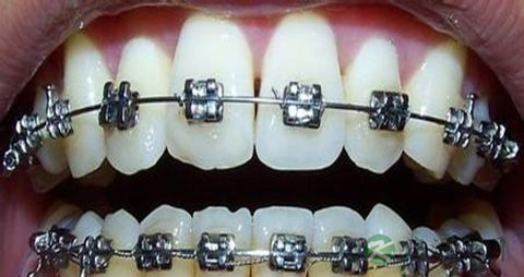 牙齿矫正吃什么
