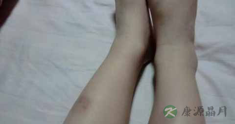 静脉血栓吃什么