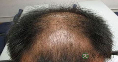 防脱发配方 防脱发配方