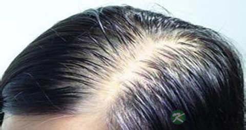 脂溢性脱发是怎样的 脂溢性脱发是怎样的