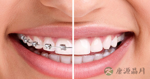 矫正牙齿可以吃什么 矫正牙齿可以吃什么