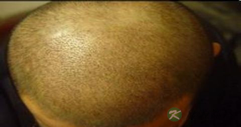 雄性激素源性脱发怎么治疗