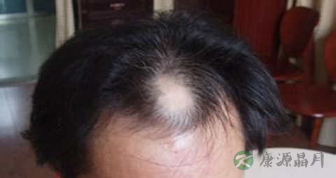 脂溢性脱发是怎样的 脂溢性脱发是怎样的