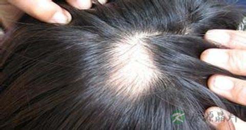有什么可以治疗脱发 有什么可以治疗脱发