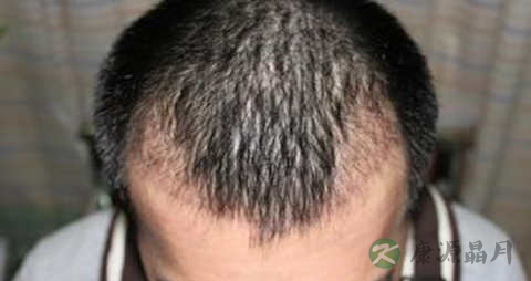 遗传性脱发的特征