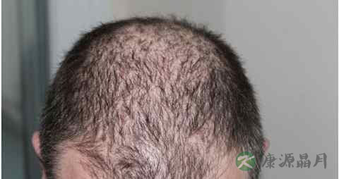 血虚脱发症状 血虚脱发症状