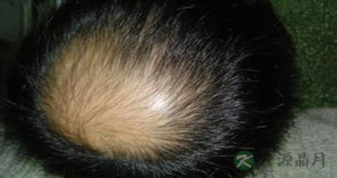 男生掉头发很厉害怎么办