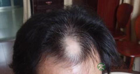 肾虚脱发严重怎么办