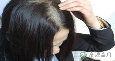 脱发特别严重怎么办 脱发特别严重怎么办