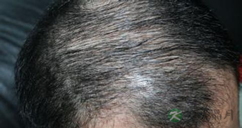 油脂性脱发怎样治疗