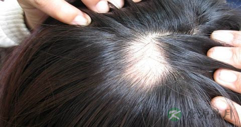 脱发的治疗方法 脱发的治疗方法