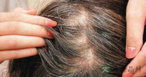 有什么办法治疗脱发 有什么办法治疗脱发