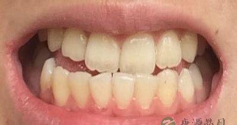 牙龈萎缩吃什么维生素