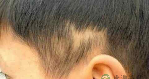 小孩掉头发怎么办 小孩掉头发怎么办