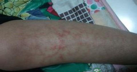 腿上有血栓吃什么