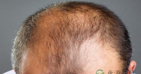 雄性脱发怎么办 雄性脱发怎么办