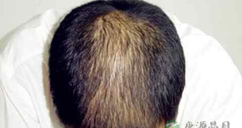 肾虚脱发原因及治疗