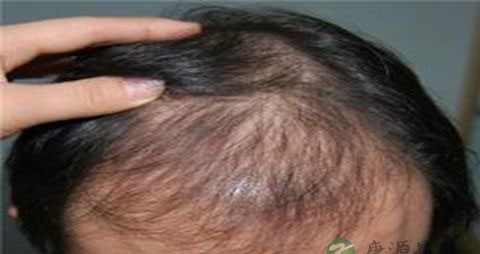 雄性激素性脱发治疗