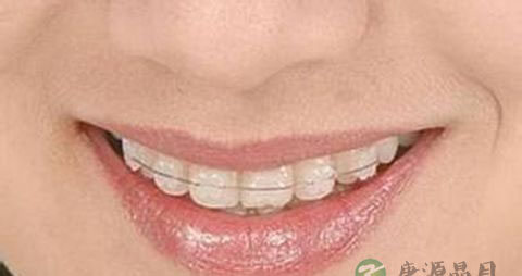 矫正牙齿后吃什么