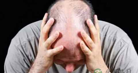 肝火旺会脱发吗 肝火旺会脱发吗